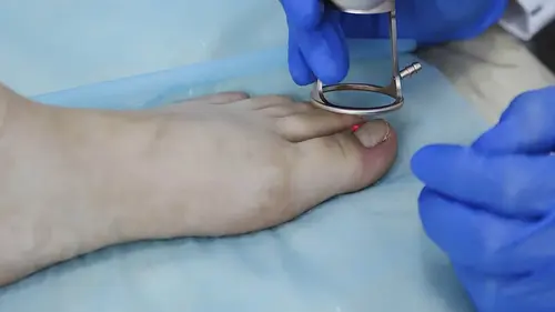 odstranjevanje vraščenega nohta na nogi